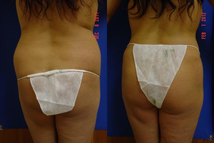 Before & After Tummy Tuck Case 84 View #4 View in San Jose, CA